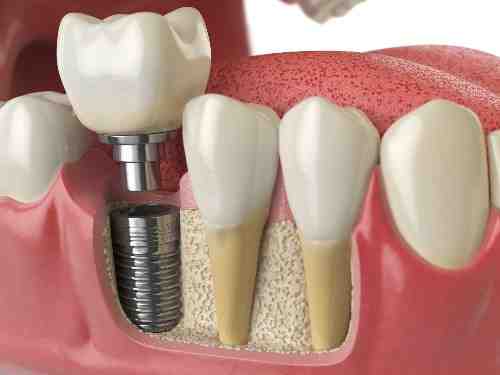 How do you clean under dental implants?