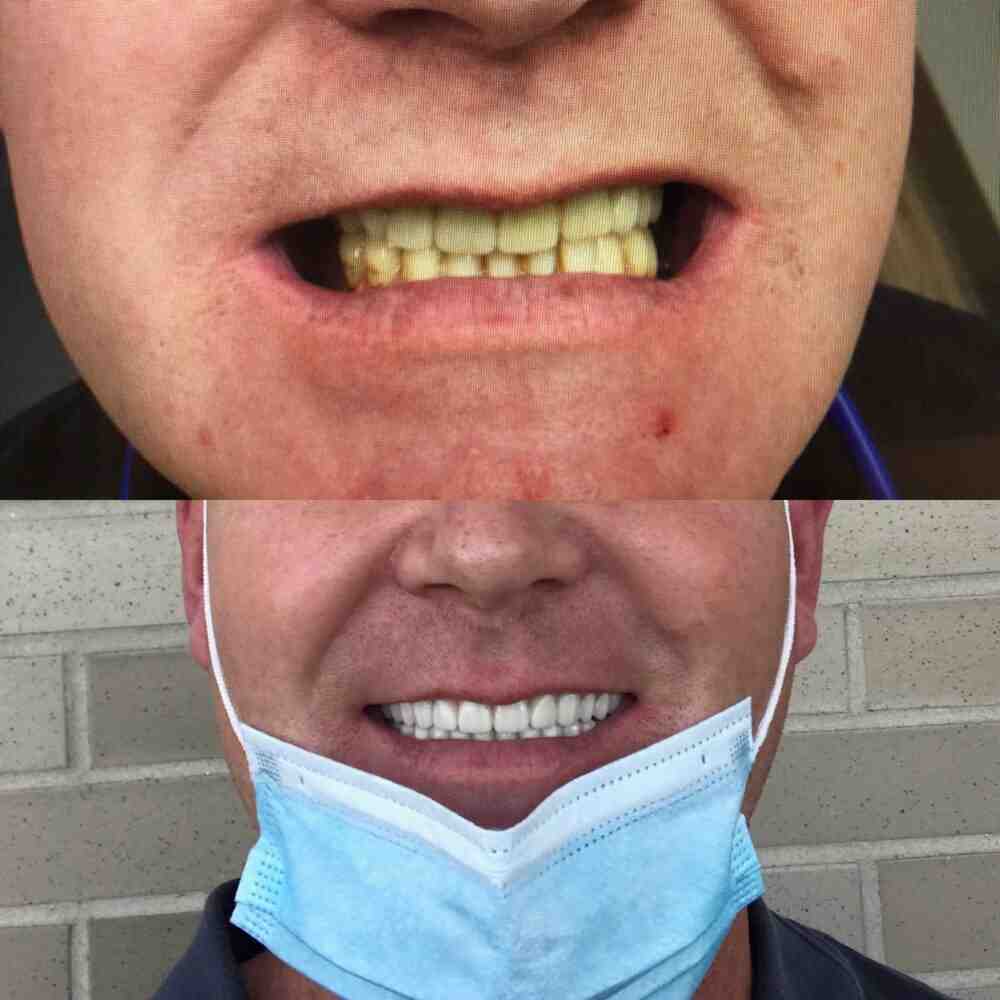 How to pay for a dental implant Dental News Network