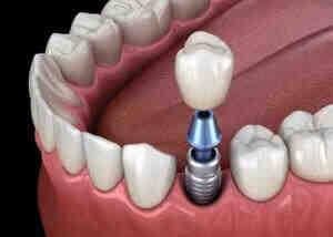 How do you get food out of dental implants?