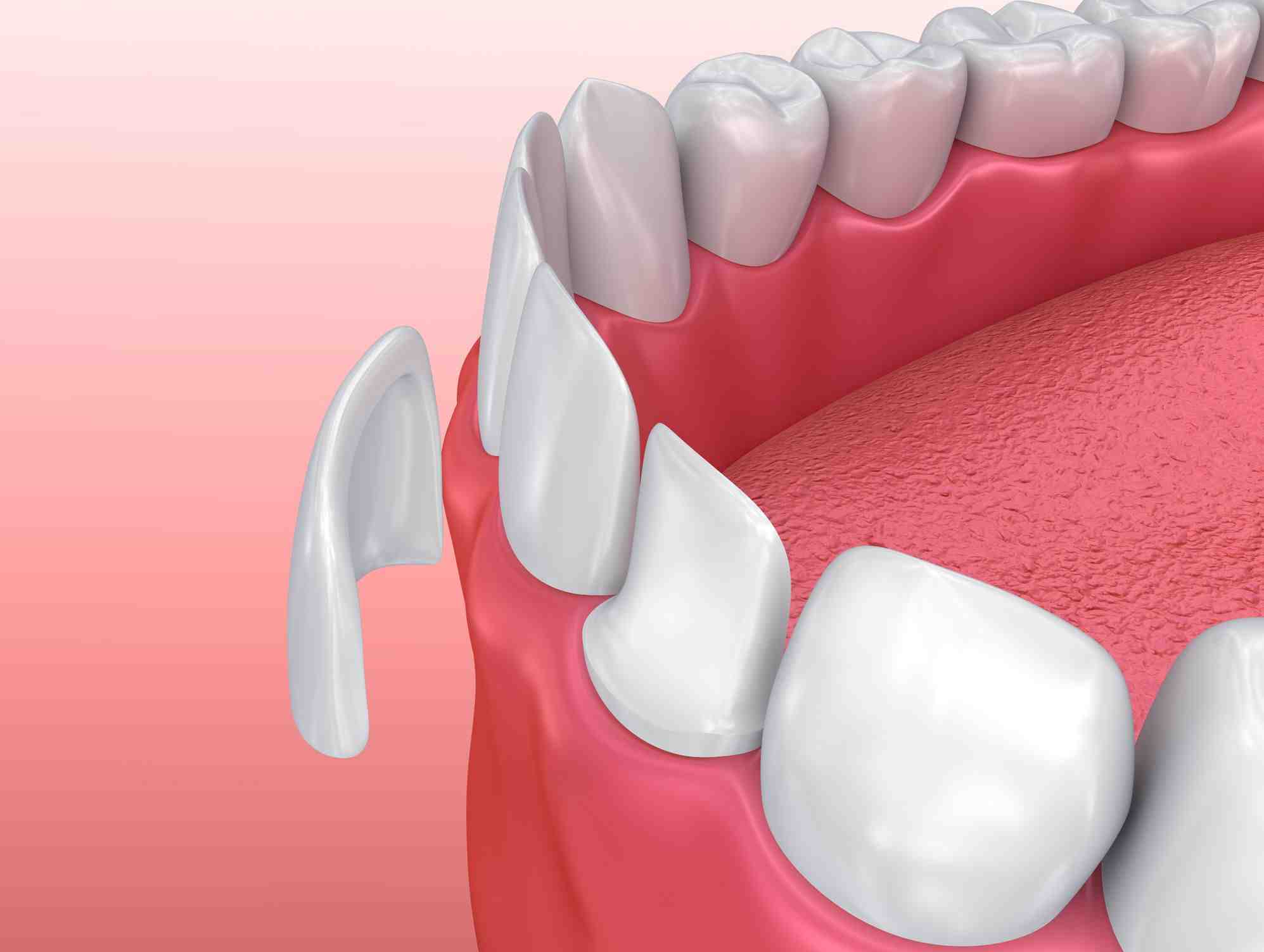How do you pay for cosmetic dentistry?