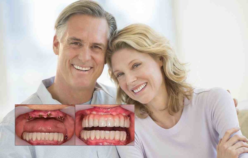 what-do-clear-choice-dental-implants-cost-dental-news-network