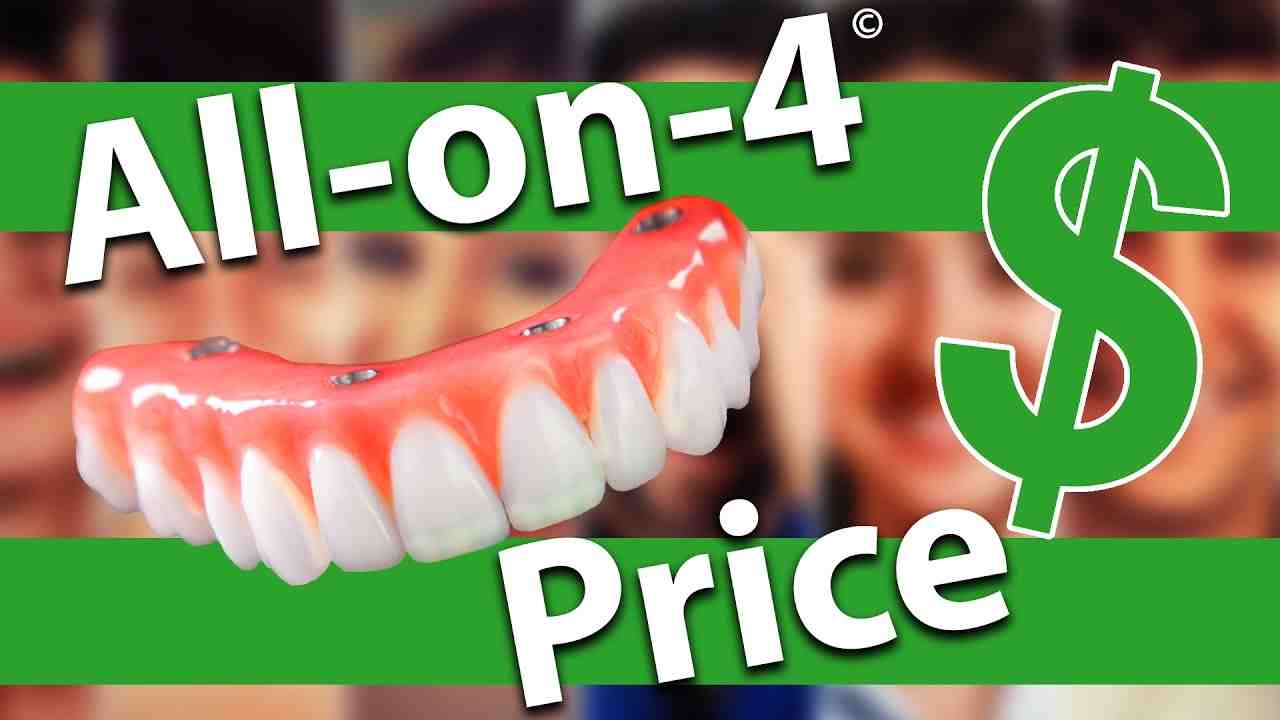 How long do all on 4 dental implants last?