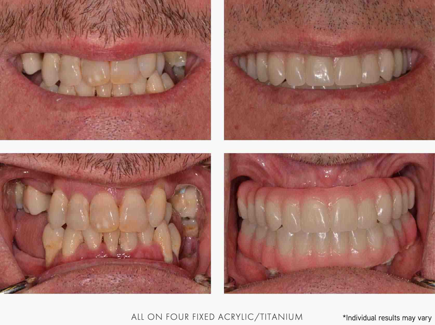 How long do all on four implants last?