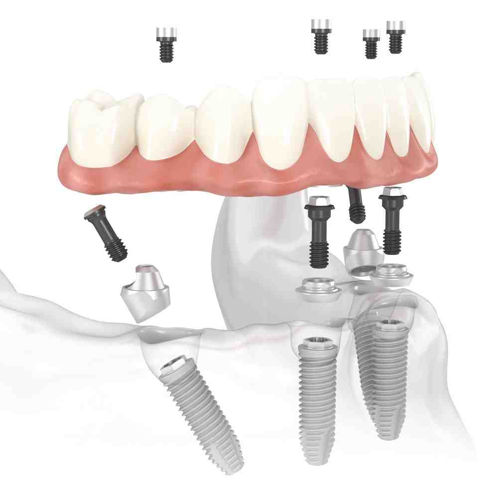 How long does an implant take from start to finish?