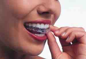 How long does composite bonding last on front teeth?