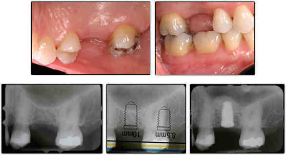 How long does dental bone graft pain last?