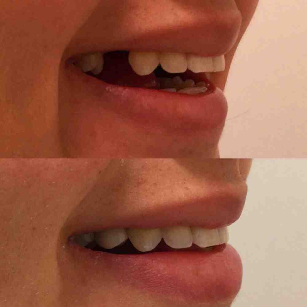 How long does it take for a tooth implant from start to finish?