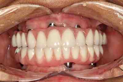 How long have teeth implants been around?