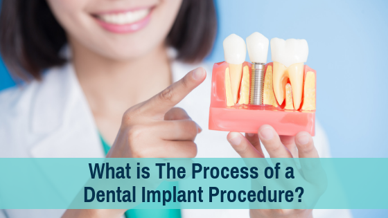 What is the process for a dental implant - Dental News Network