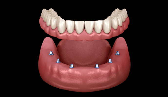 How long is dental implant process?