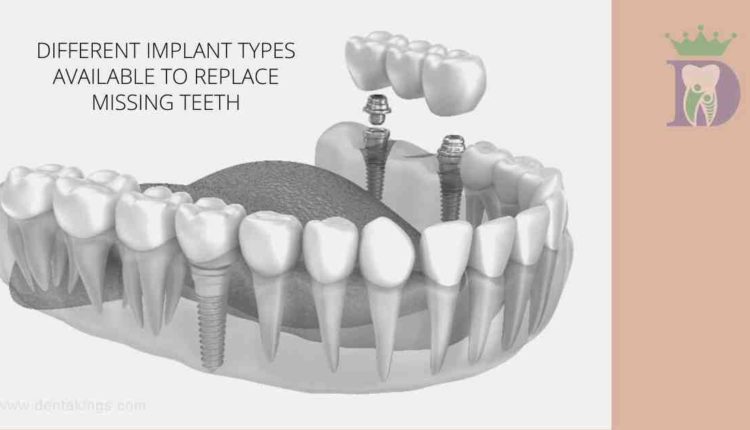 How many dental implants to replace all teeth