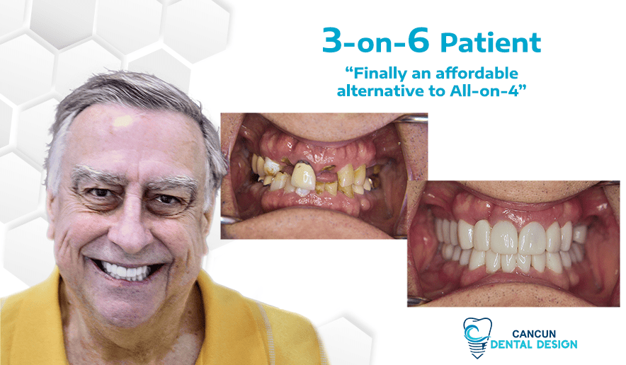 How many stages of dental implants are there?