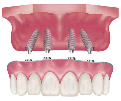 How many teeth are on All-on-4 dental implants?