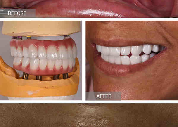 How many teeth are on an all on 4 dental implants