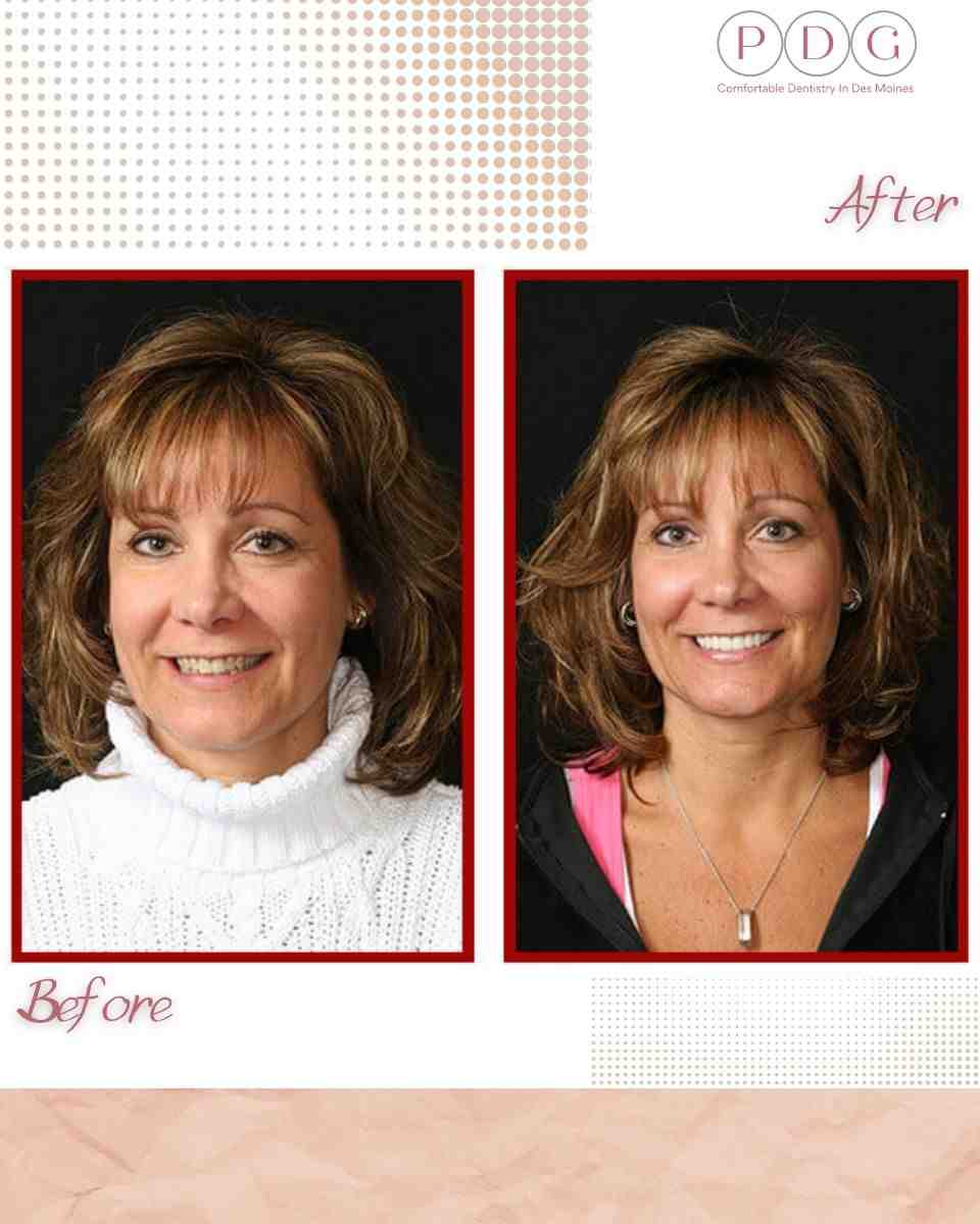 How much do Dr APA veneers cost?