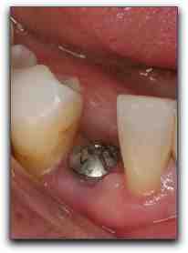 How much do celebrities pay for veneers?