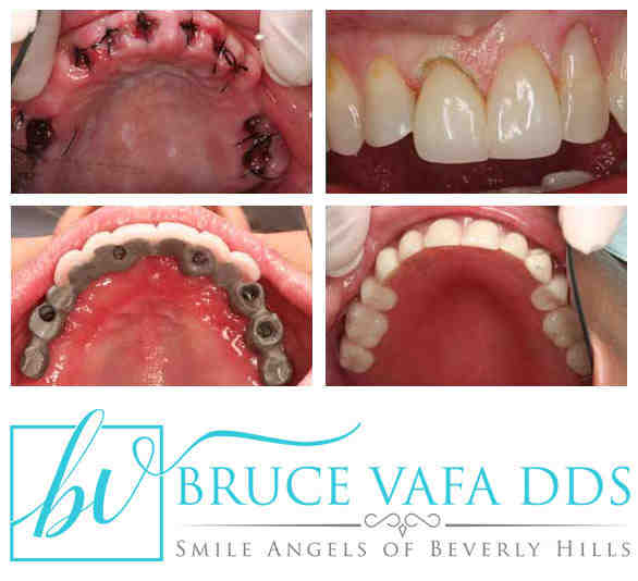 How much do dental implants cost 2020?