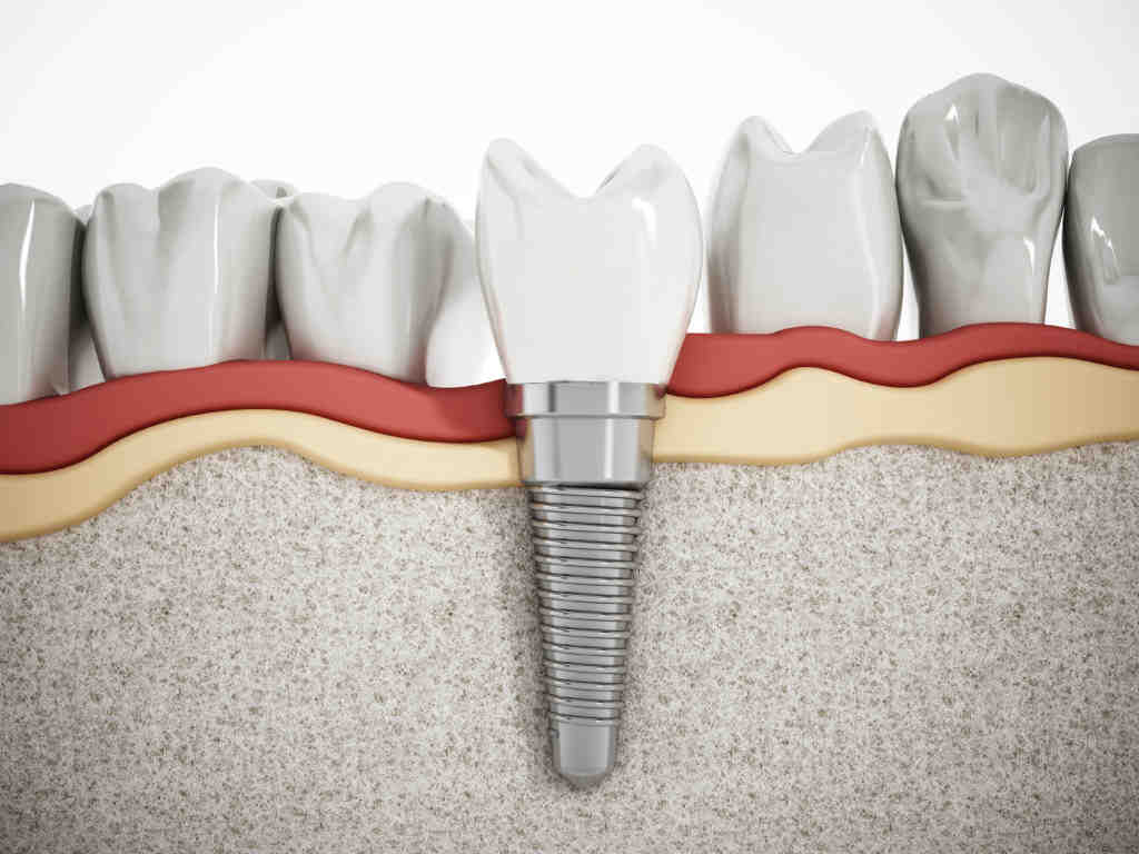 What should dental implants cost in fort wayne indiana Dental News
