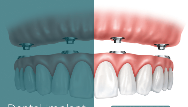 How much do dental implants cost in texas