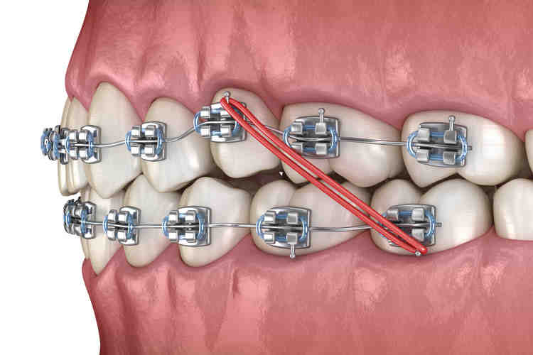 How much do full dental implants cost with insurance?