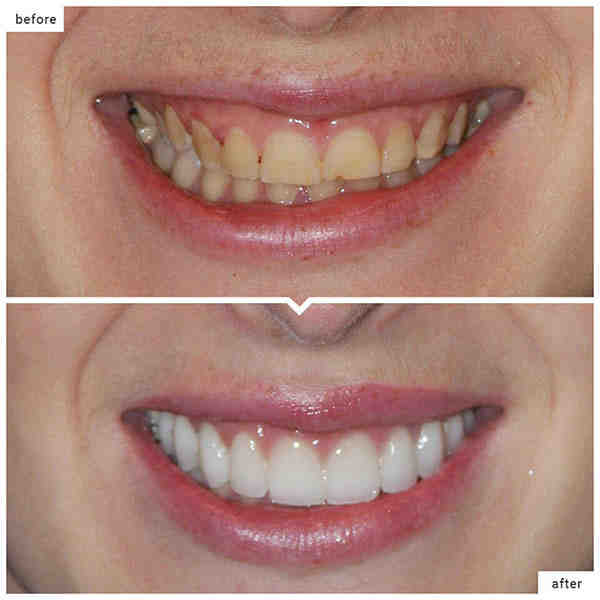 Cosmetic dentistry veneers images Dental News Network