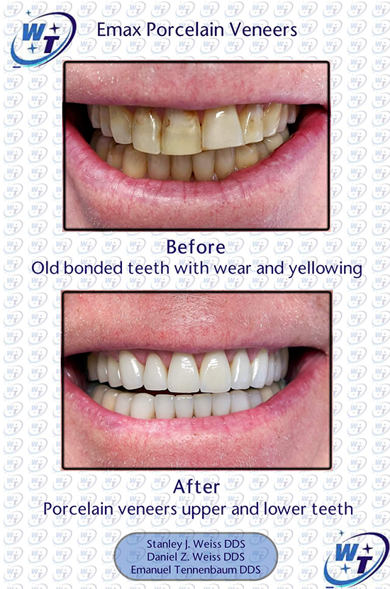 How much do veneers cost for 4 teeth?