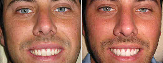 How much do veneers cost in Los Angeles?