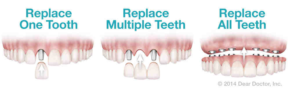 How much does 3 teeth implants cost?