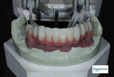 How much does Clearchoice dental implants cost?