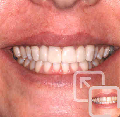 How much does a cosmetic tooth filling cost?