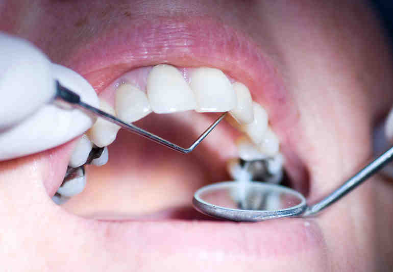How much does a cosmetic tooth filling cost?