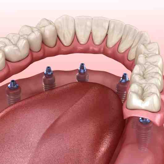 How much does a dental implant cost for one tooth?