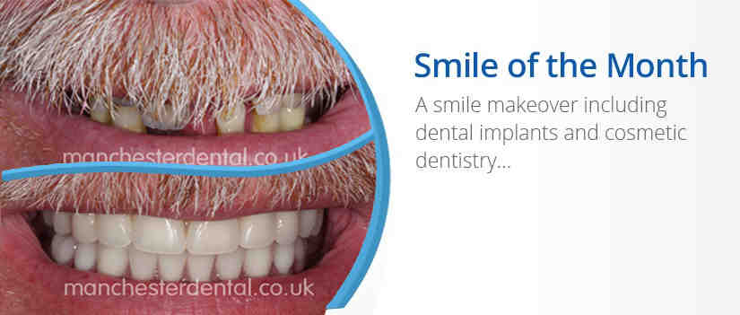 How much does a full mouth of veneers cost UK?