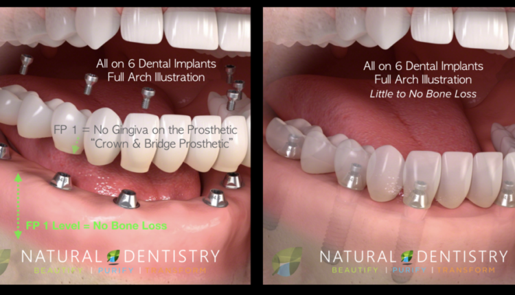 How much does clear choice cost for dental implants full mouth