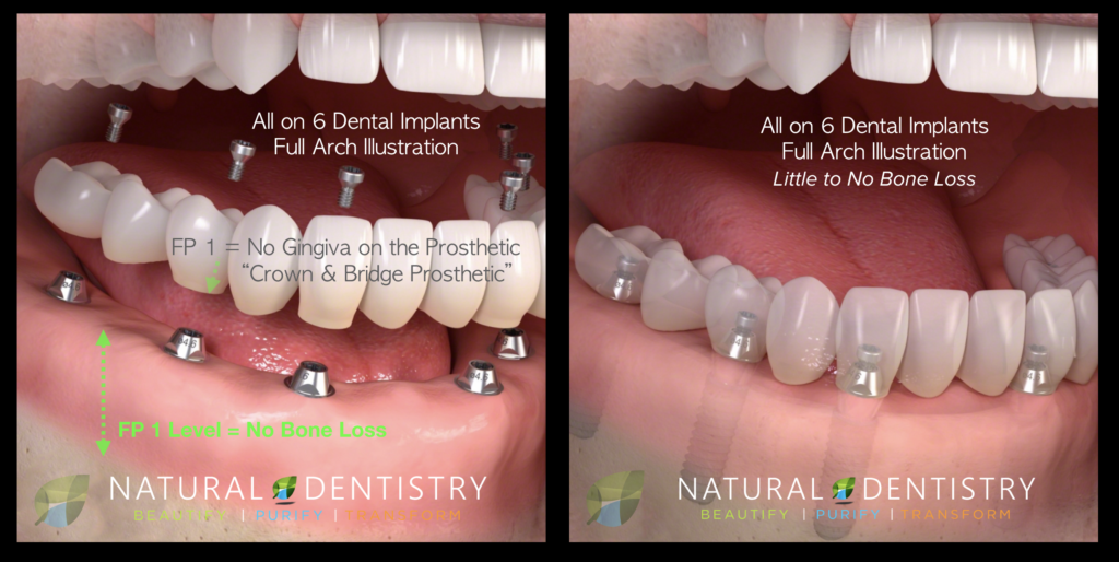 How Much Does Clear Choice Cost For Dental Implants Full Mouth Dental 