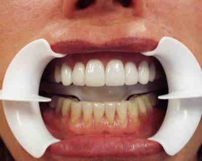 How much does dental smile cost?