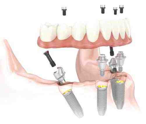 How much does it cost for All-on-4 implants?