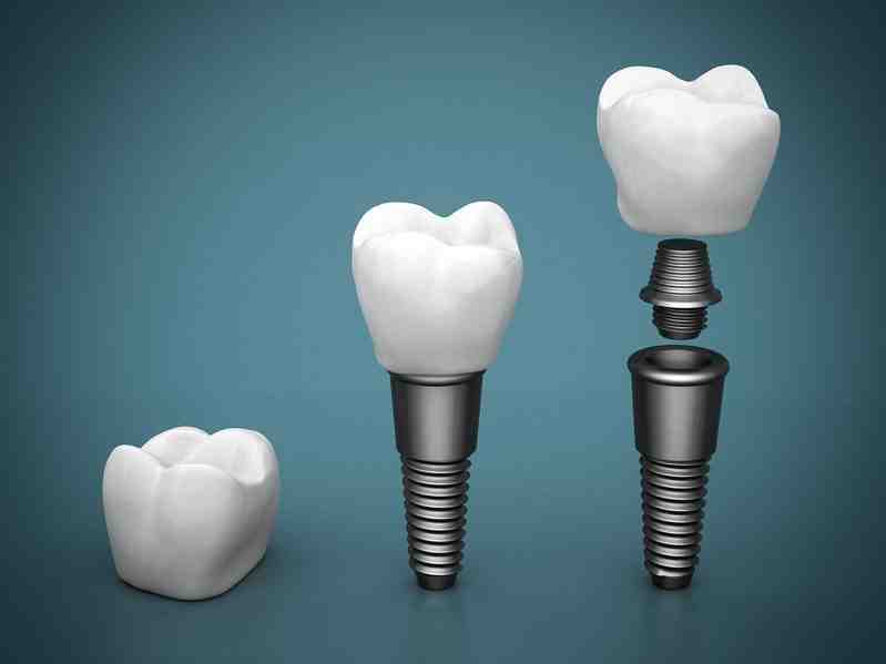 does-florida-blue-cover-dental-implants-dental-news-network