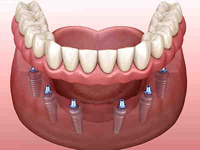 How much does it cost to get a full mouth of dental implants?