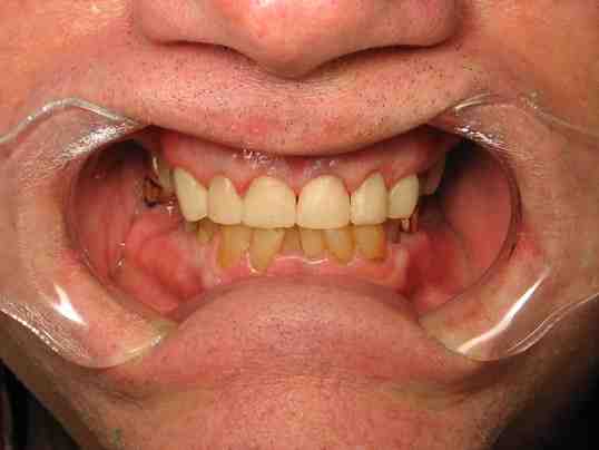 How much does it cost to get a tooth makeover?