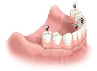 How much does it cost to get all implants teeth?