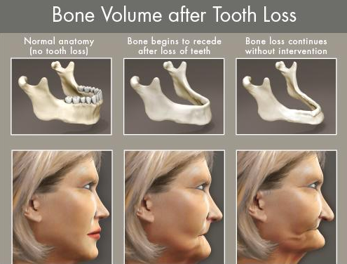 How much does it cost to replace all your teeth?