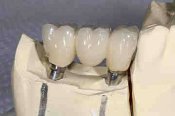 How much does the 3 on 6 dental implants cost?