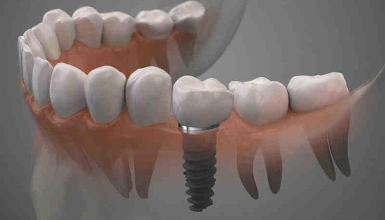 How much for complete dental implants