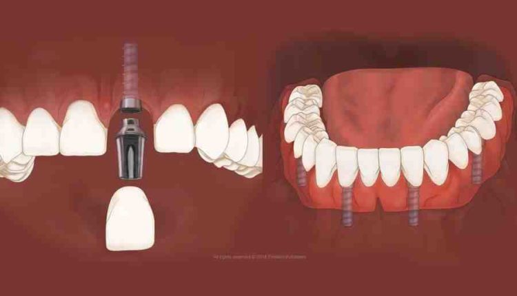 How much for dental implants south florida