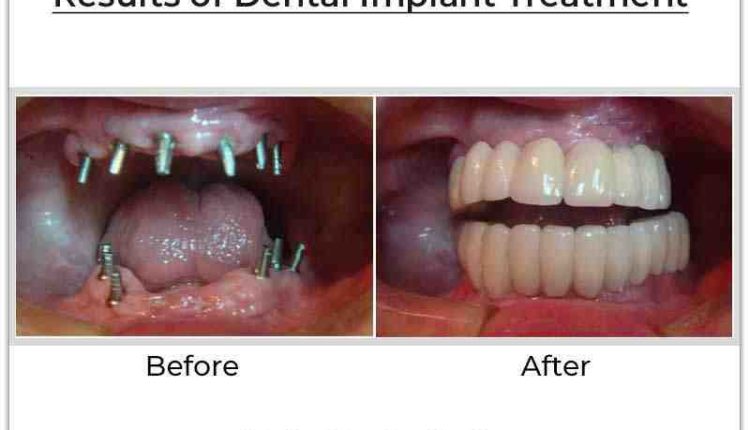 How much is dental implants cost