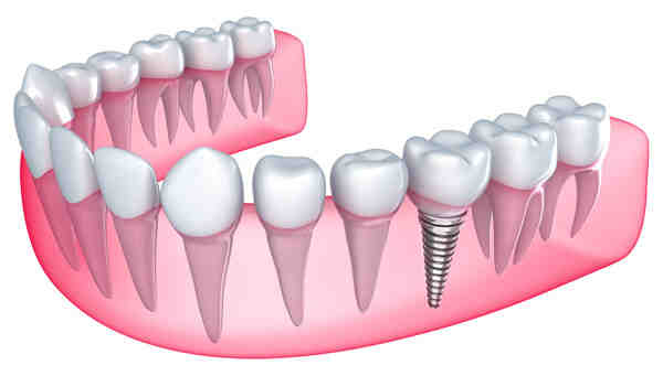 How much is implants per tooth?