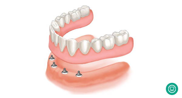 How much should dental implants cost in 2020?