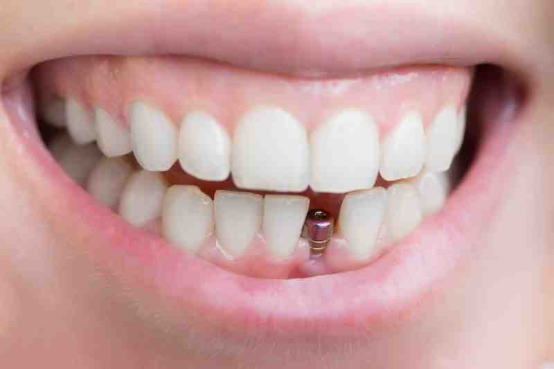 How much will dental implants cost in 2020?