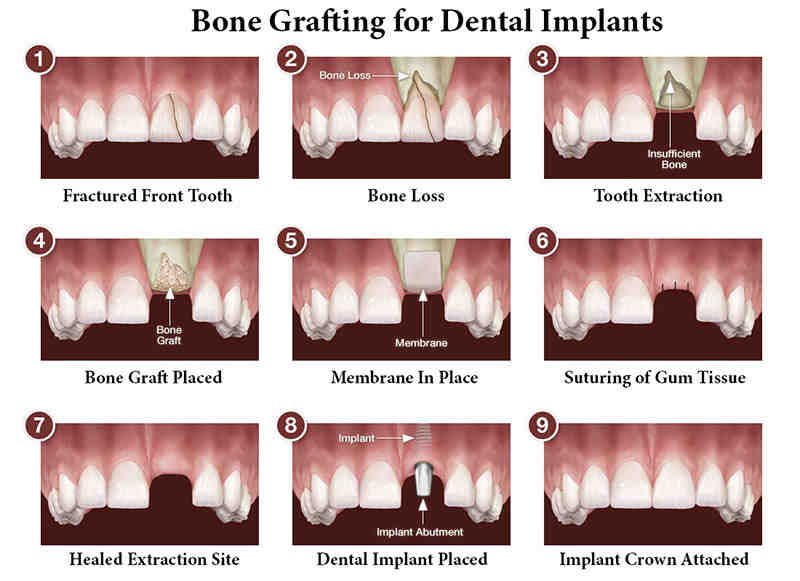 How successful are dental bone grafts?